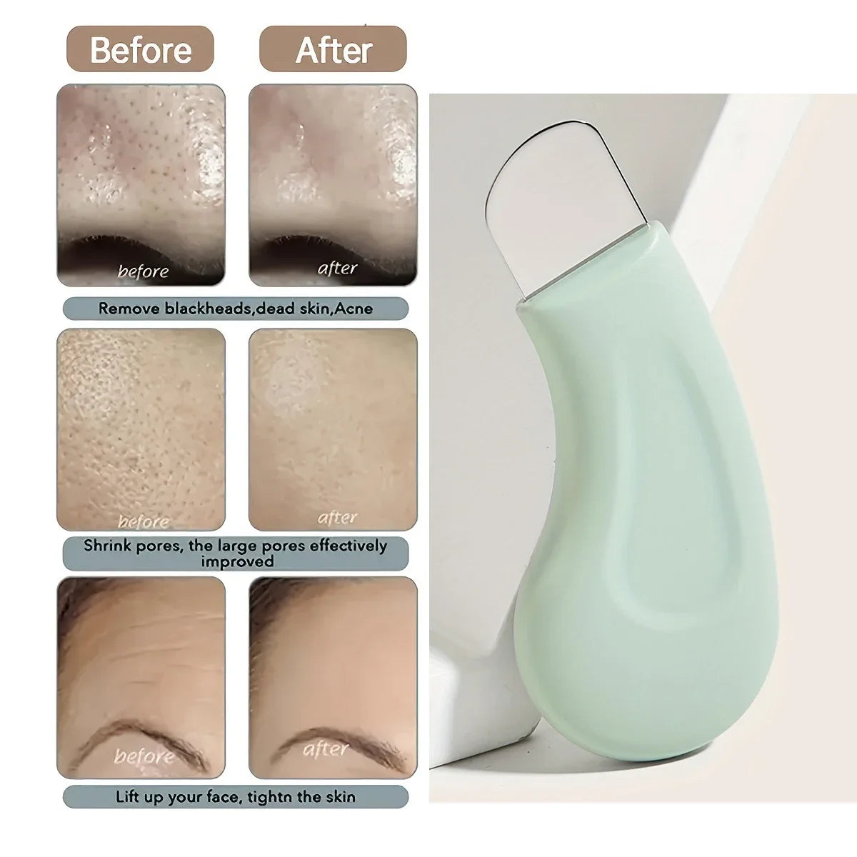 Blackhead & Whitehead Removal